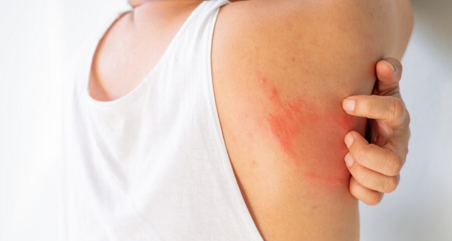 Calor e umidade elevam casos de micose no verão, indica estudo de dez anos - Imagem do artigo